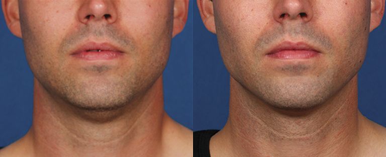 Kybella Dallas