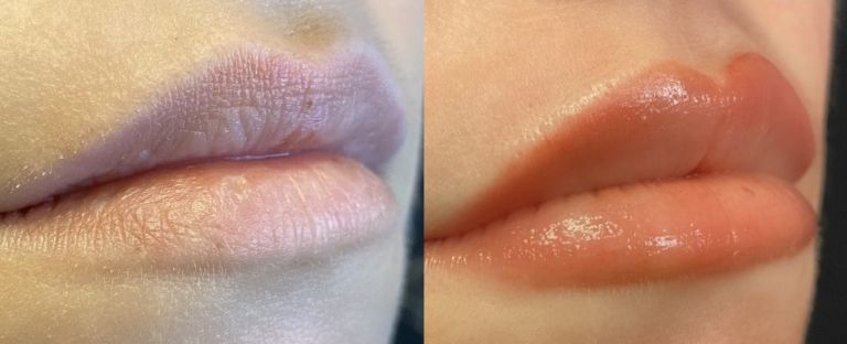 Lip Filler BA Dallas