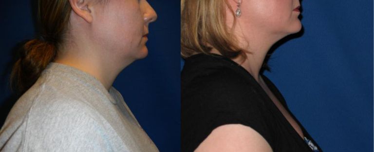 Kybella Dallas