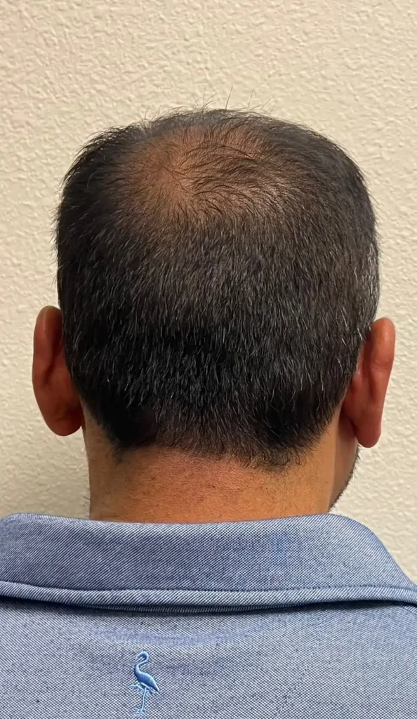 PRP Hair Restoration Dallas
