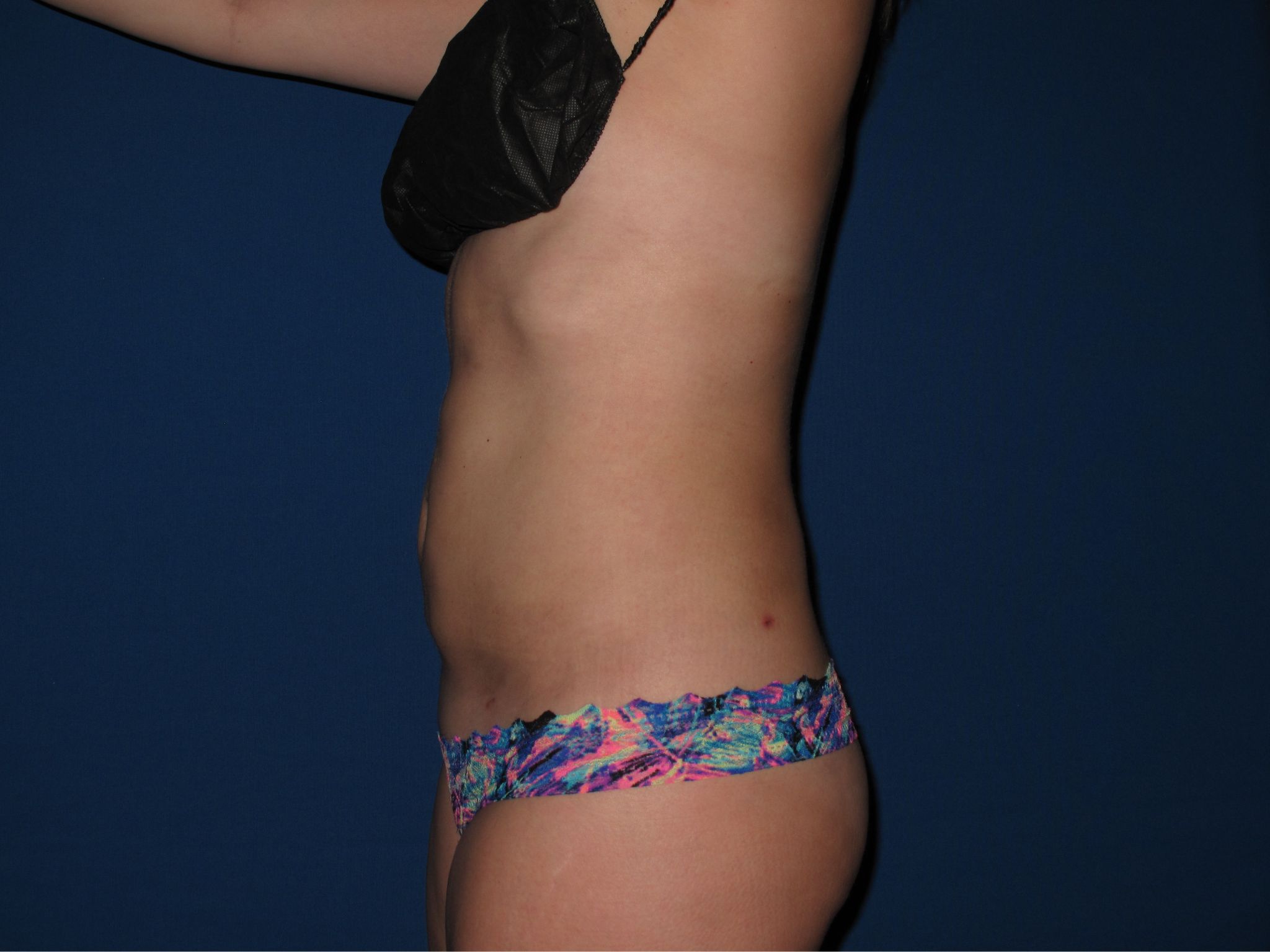 Liposuction Dallas