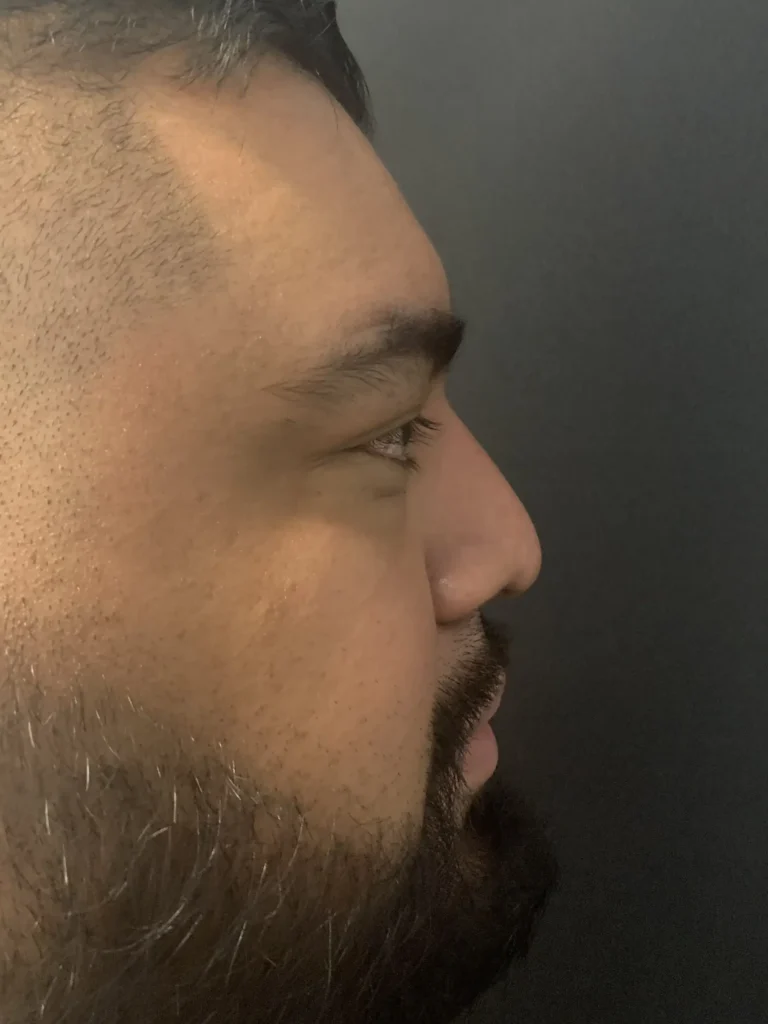 PhotoFacial Dallas