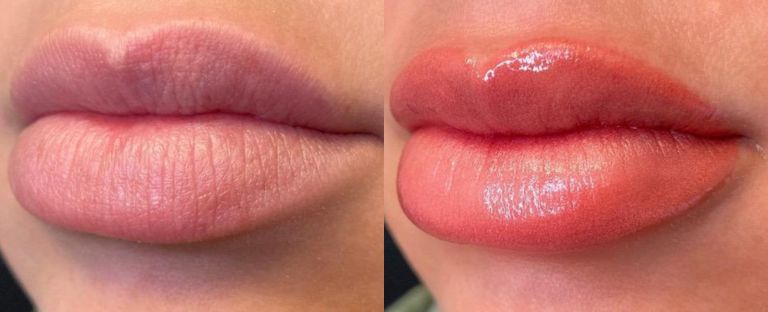 Lip Filler BA Dallas
