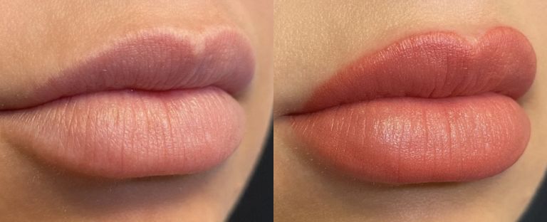 Lip Filler BA Dallas