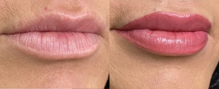 Lip Filler BA Dallas