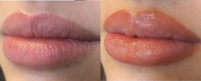 Lip Filler BA Dallas