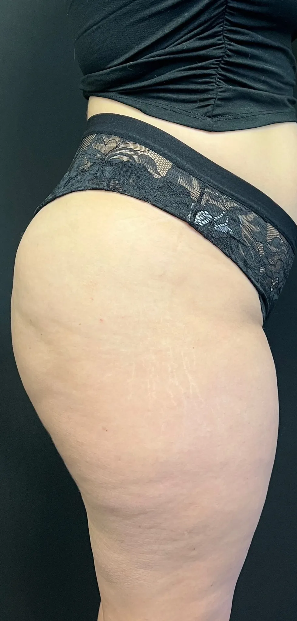 Brazilian Butt Lift Case1403 1
