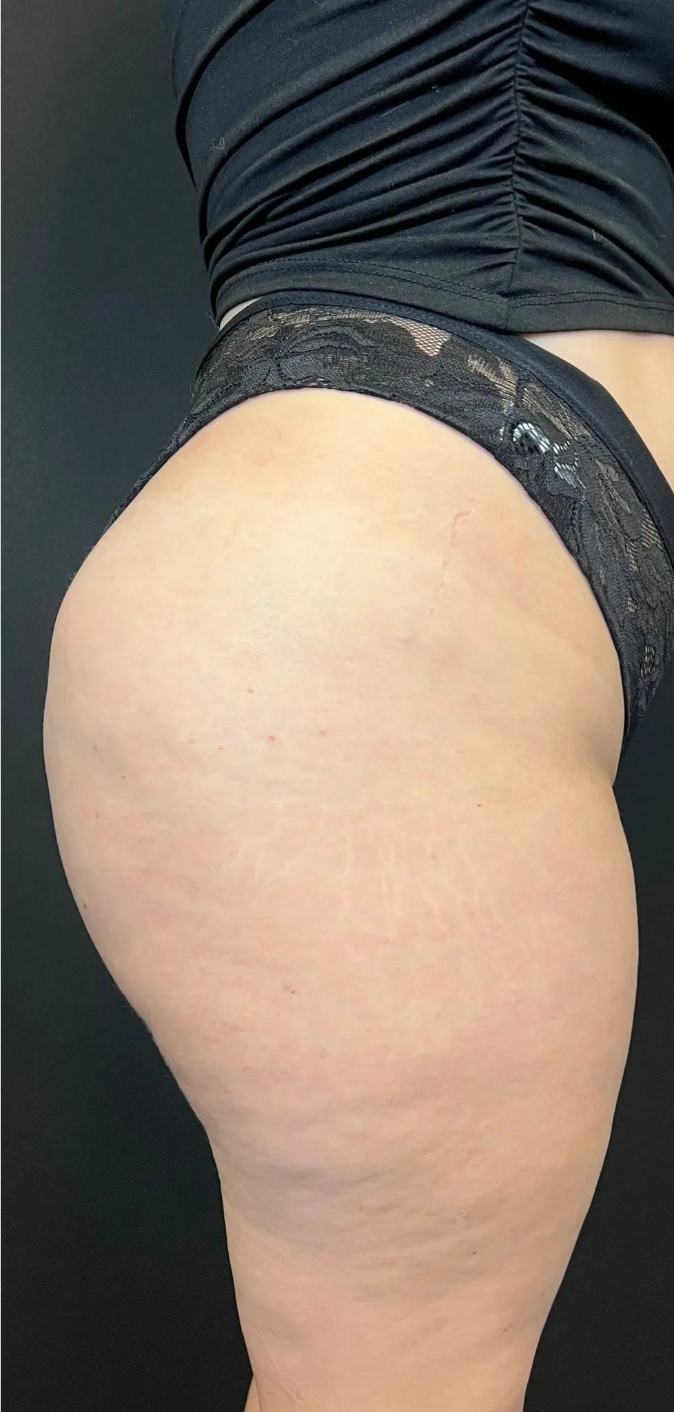 Brazilian Butt Lift Case1403 2