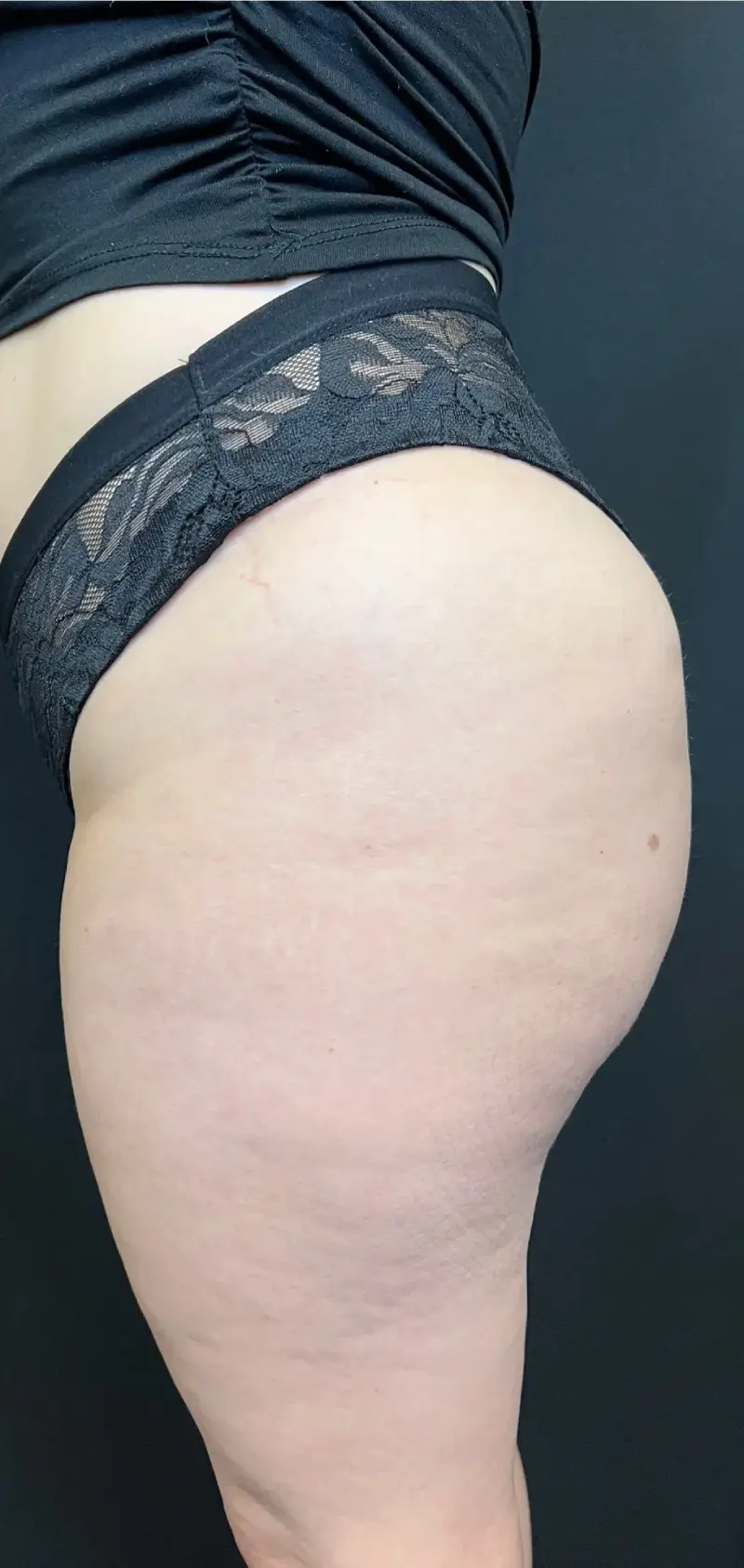 Brazilian Butt Lift Case1403 3