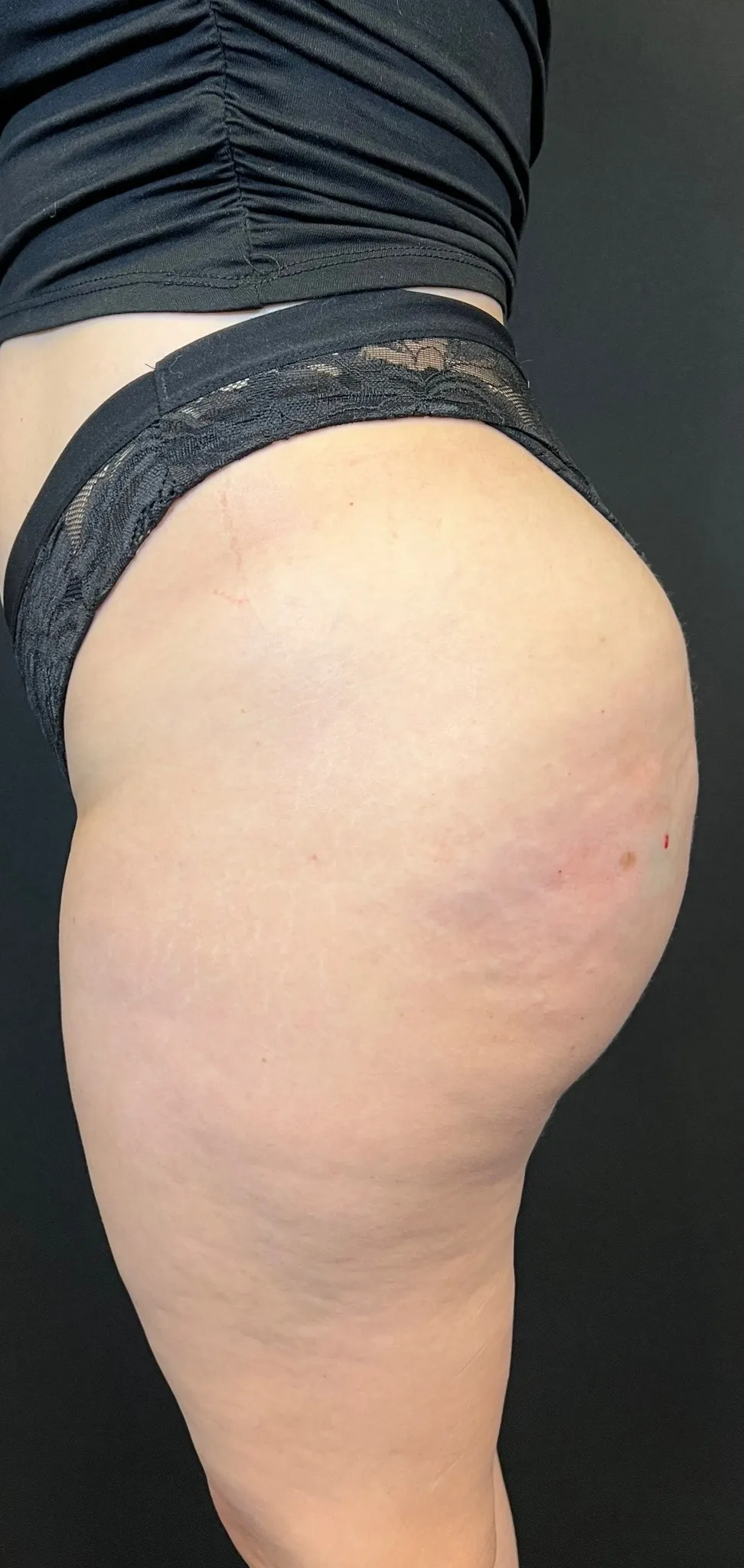 Brazilian Butt Lift Case1403 4