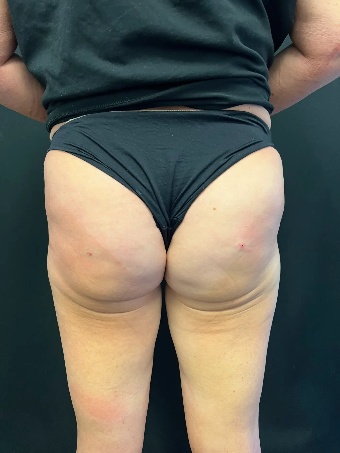 Brazilian butt lift Case 1404 2