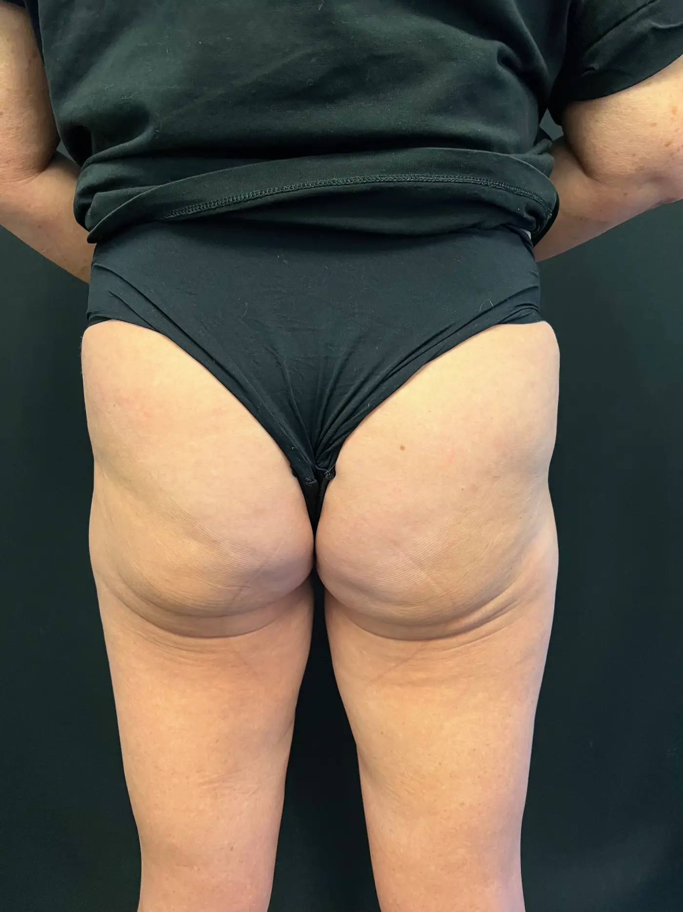 Brazilian butt lift Case 1404 1