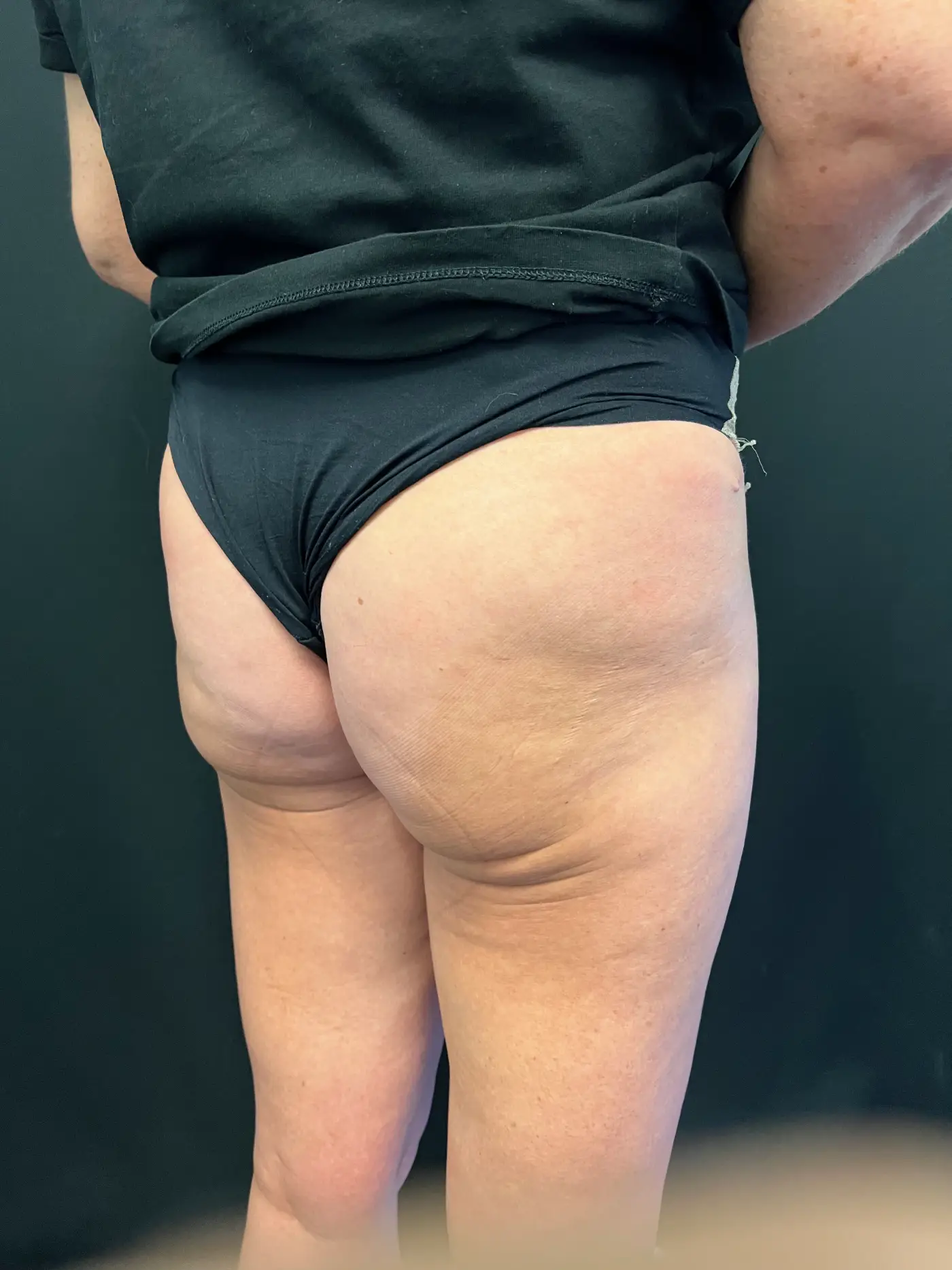 Brazilian butt lift Case 1404 3