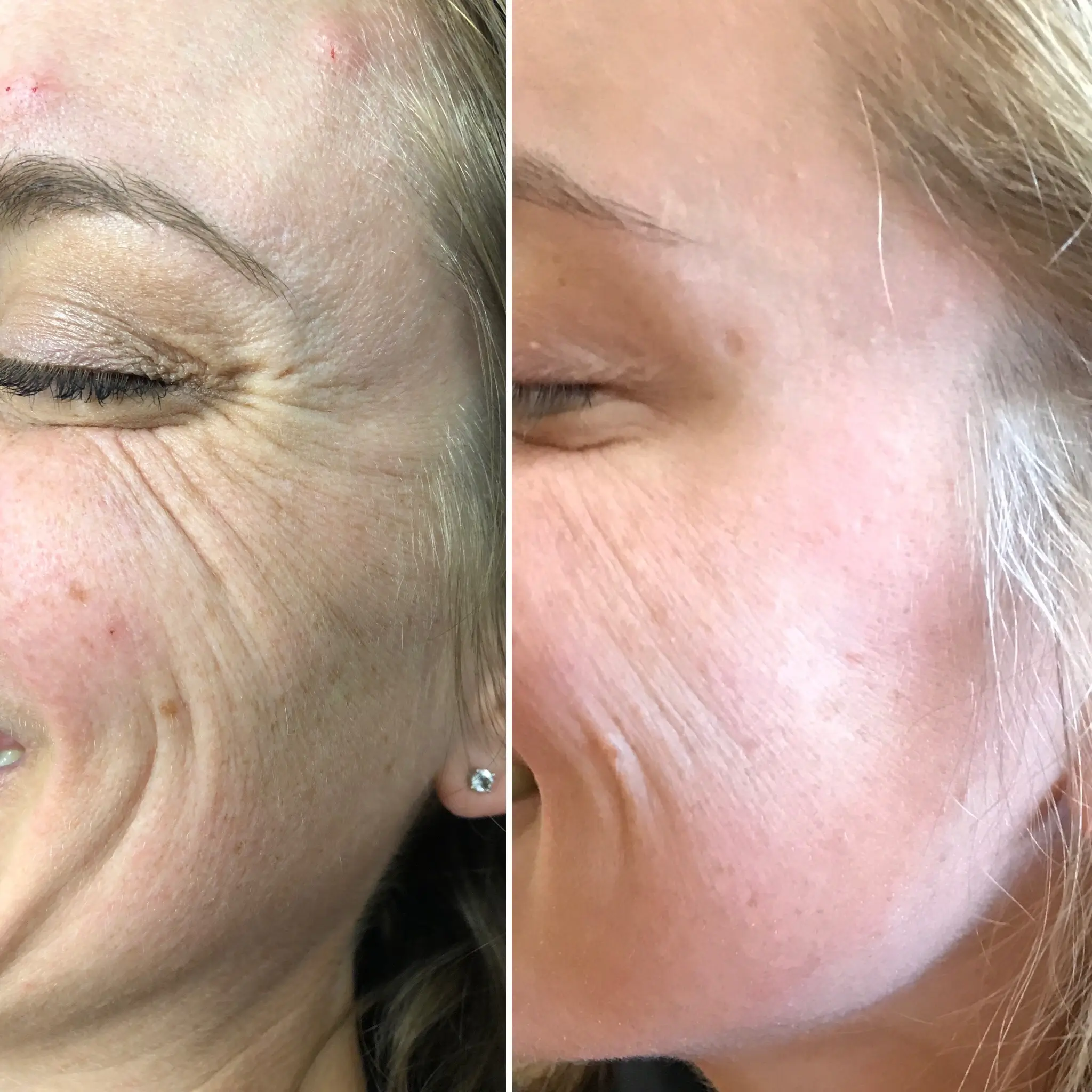 Rejuve Med-Spa Gallery After Image at Dallas & Plano