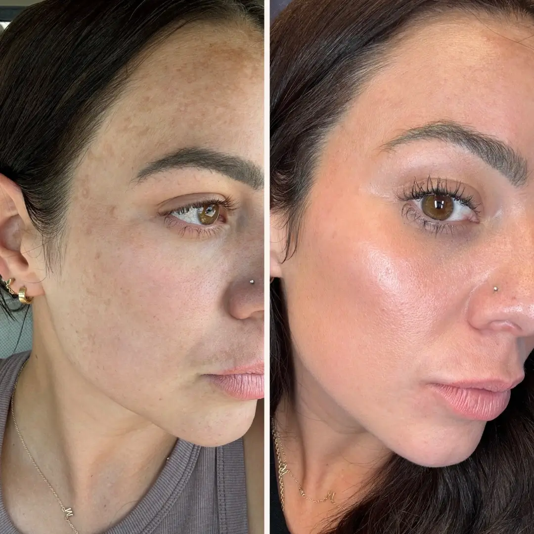 Rejuve Med-Spa Gallery After Image at Dallas & Plano