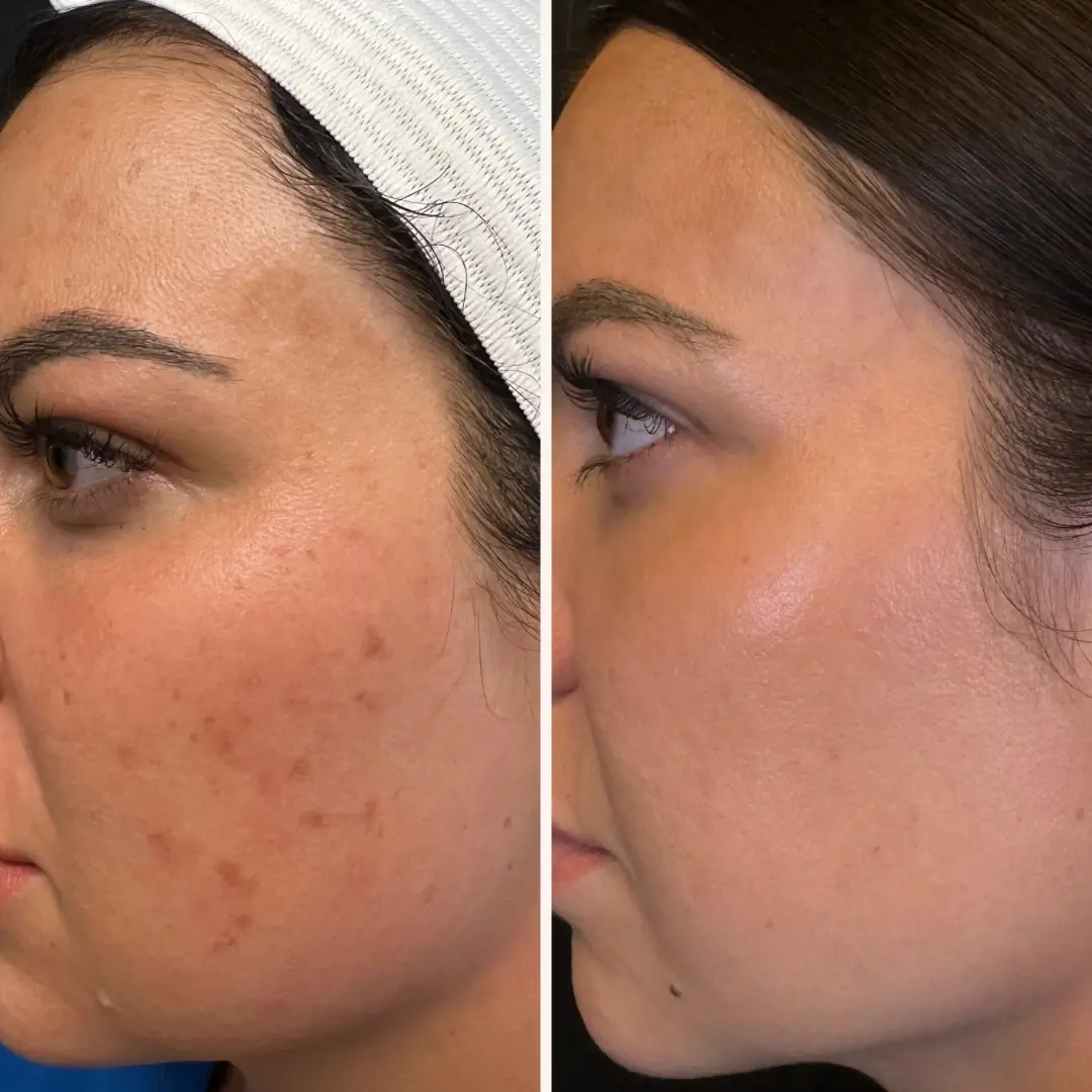 Rejuve Med-Spa Gallery After Image at Dallas & Plano