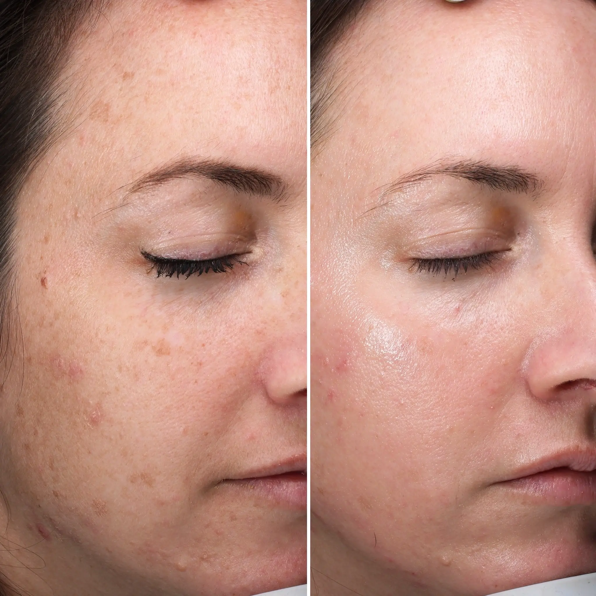 Rejuve Med-Spa Gallery After Image at Dallas & Plano