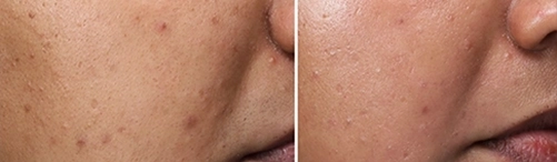 Before and After results | Hydrafacial Treatments