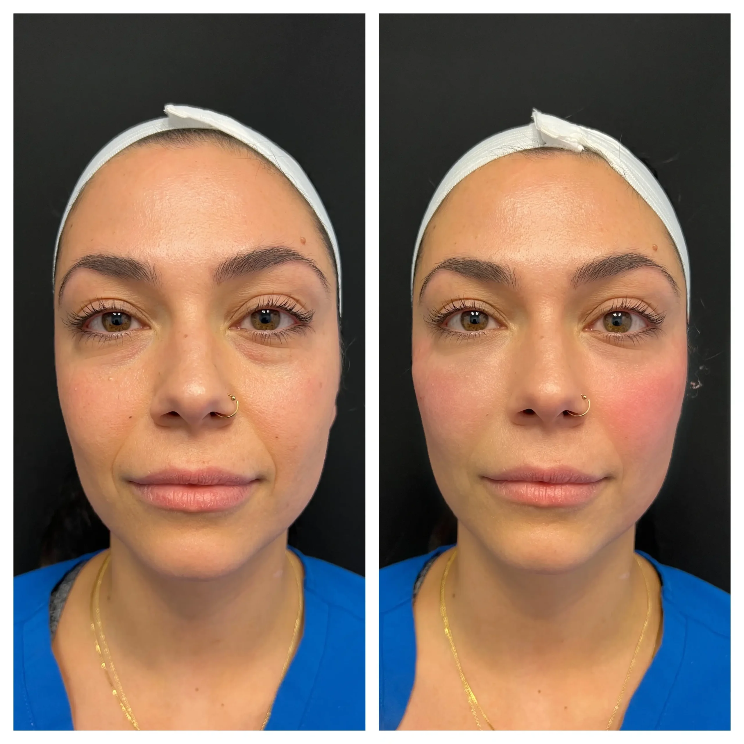Rejuve Med-Spa Gallery After Image at Dallas & Plano