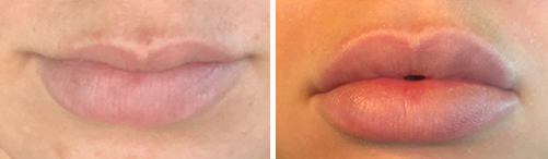 Before and After Dermal -rejuve-med-spa-in-dallas-tx