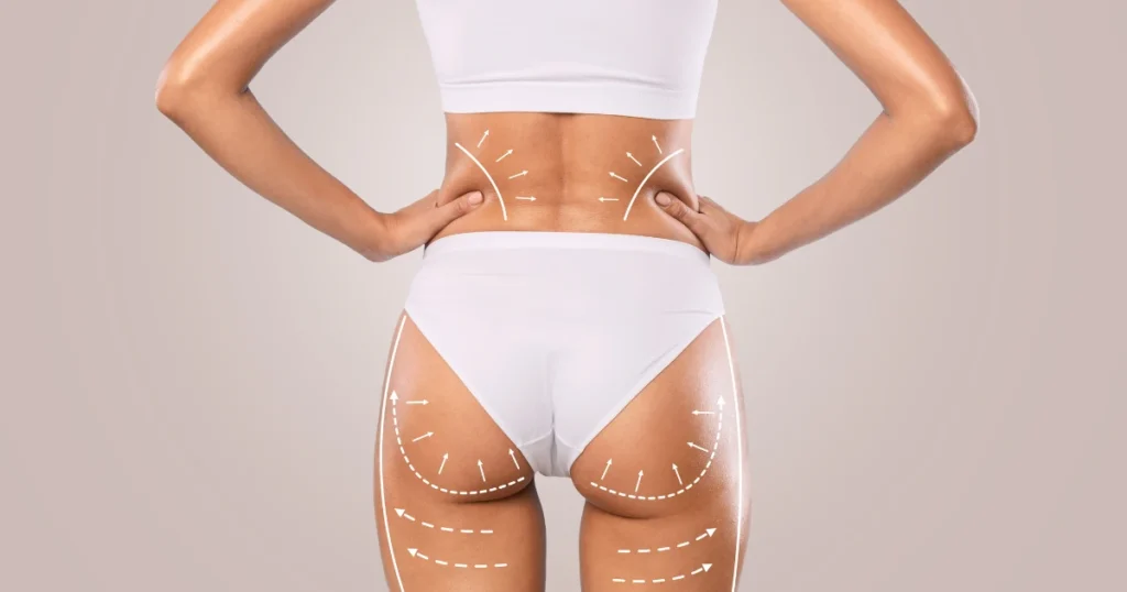 Liquid BBL Or Traditional BBL: Safer Alternatives 1 A woman with radiant, rejuvenated skin following non-surgical brazilian butt lift treatments