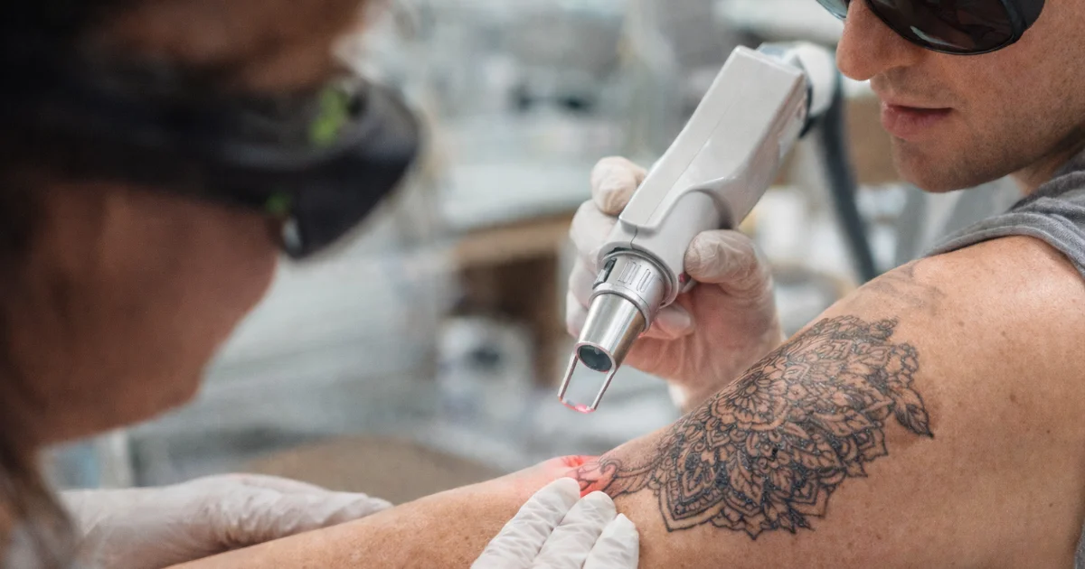 Client Experiencing Laser Tattoo removal at Rejuve Medspa