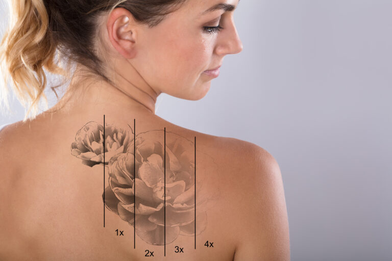 Does Laser Tattoo Removal Hurt?