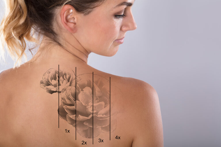 How Much Does Laser Tattoo Removal Cost?