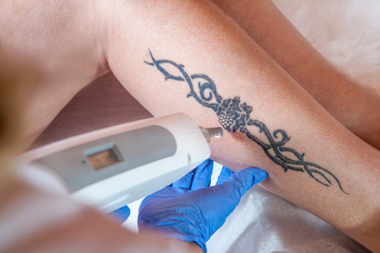 How Many Sessions Does it Take for Laser Tattoo Removal?