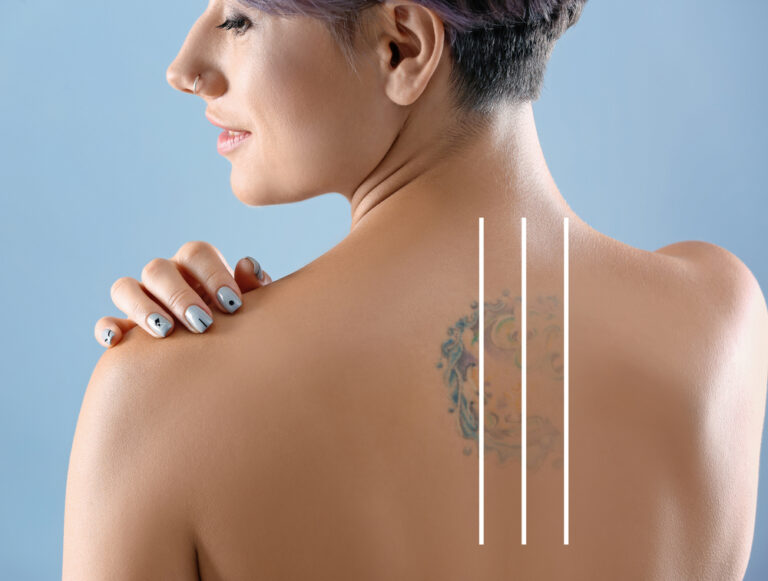 What You Need to Know About Laser Tattoo Removal