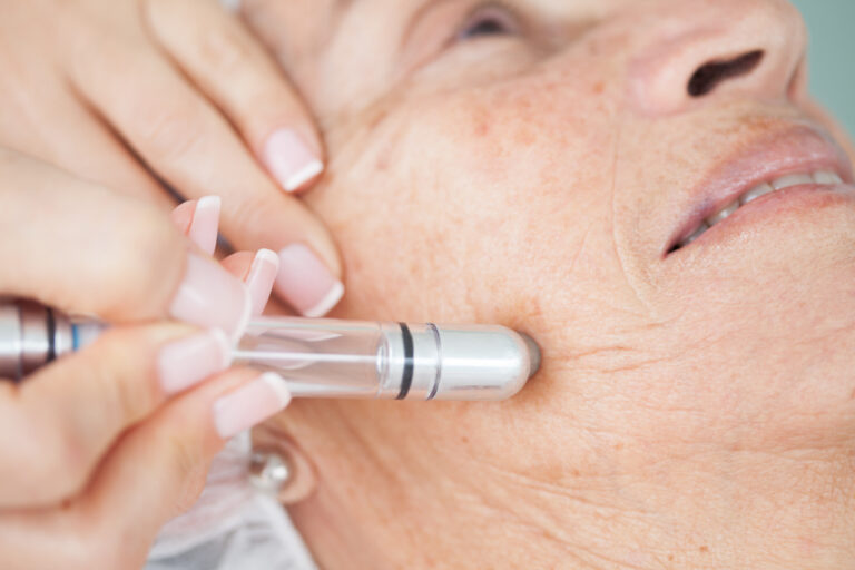 What is PRP Microneedling?