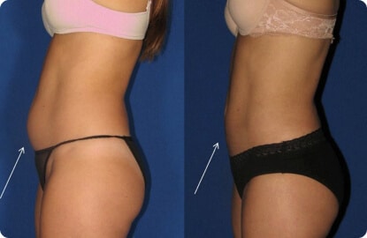 Laser Lipo Dallas Plano