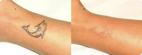 Laser Tattoo Removal Dallas