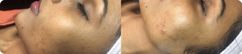 SkinPen Microneedling Dallas