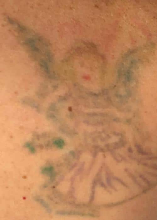 After Tattoo REmoval