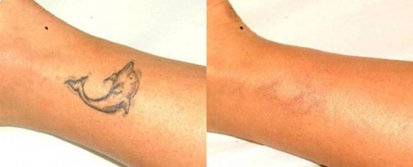 tattoo removal dallas