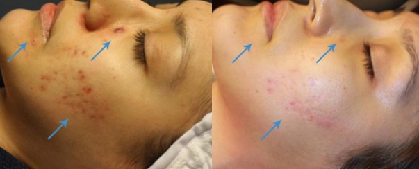 Chemical Peel Plano