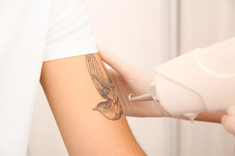 Can Laser Tattoo Removal Get Rid of My Tattoo Completely?