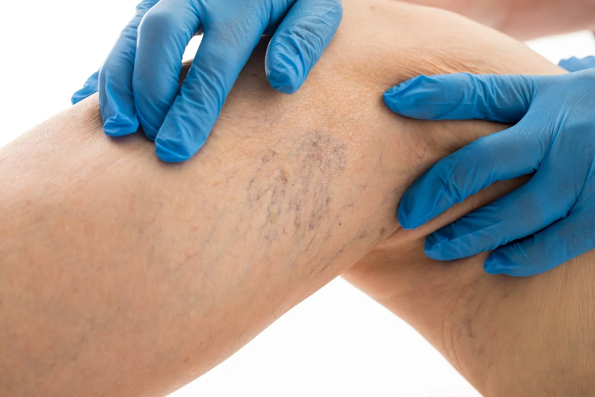 Underarm hair removal consultation by aesthetic specialist