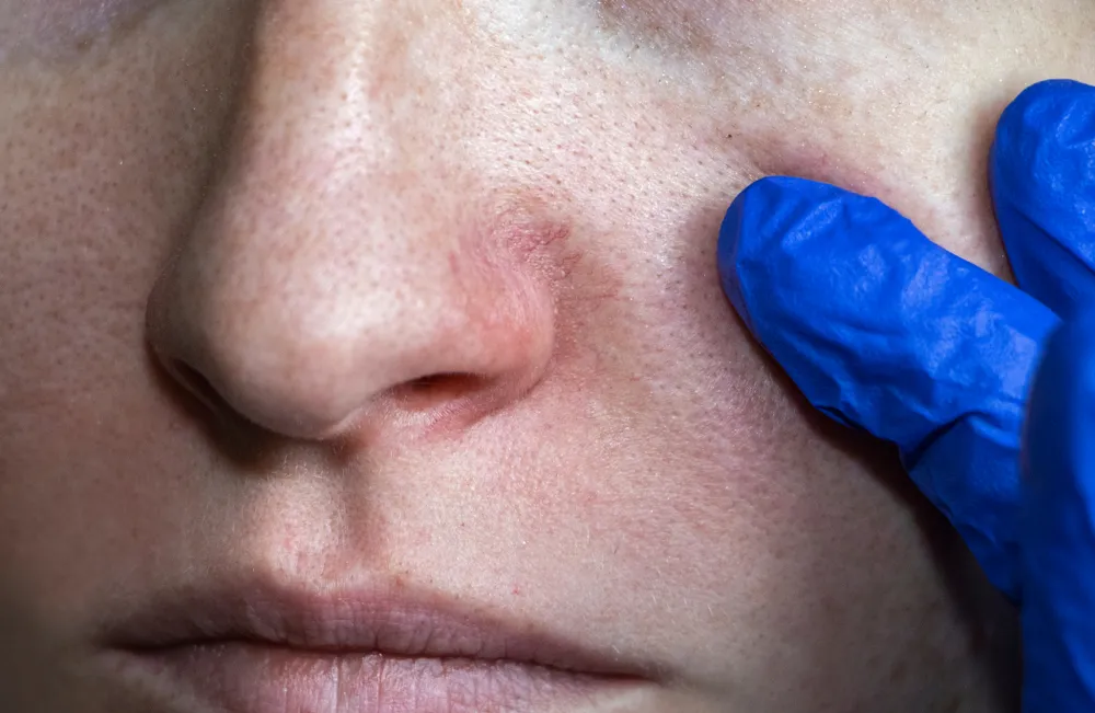 Close-up of nose showing blackheads and skin texture