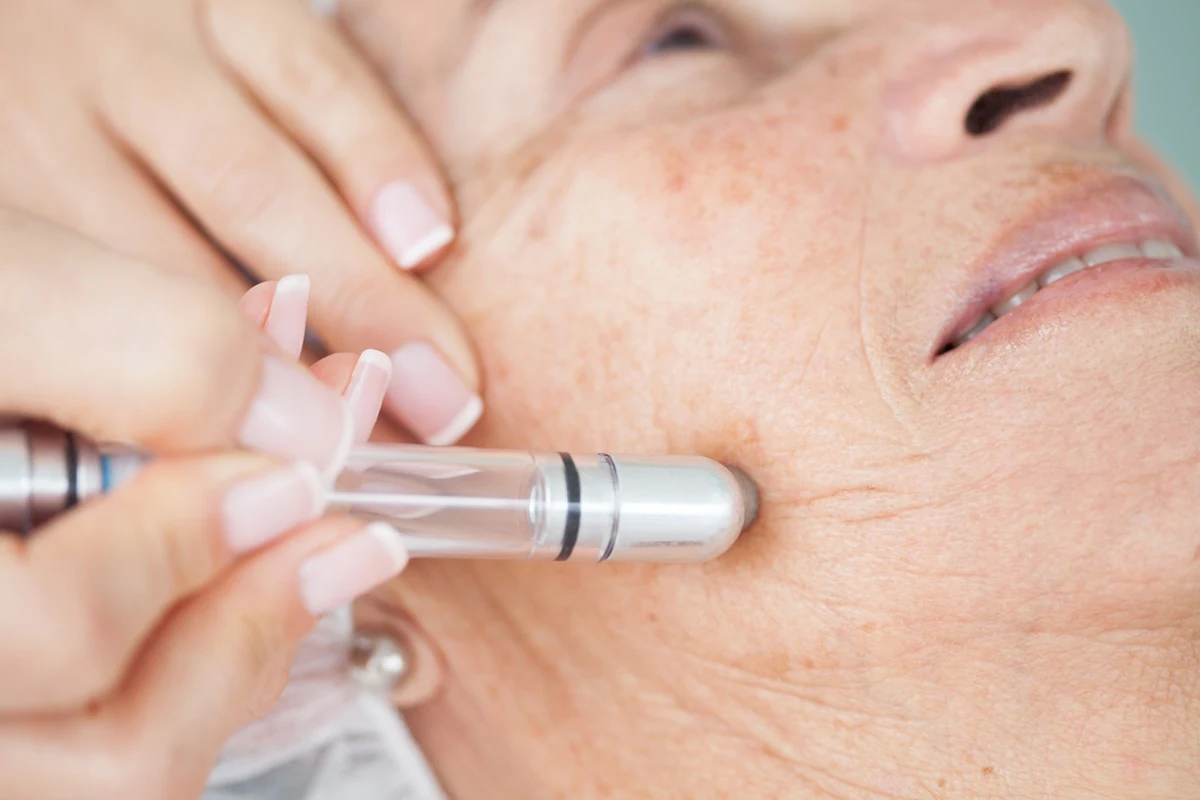 PRP Microneedling facial treatment for skin rejuvenation