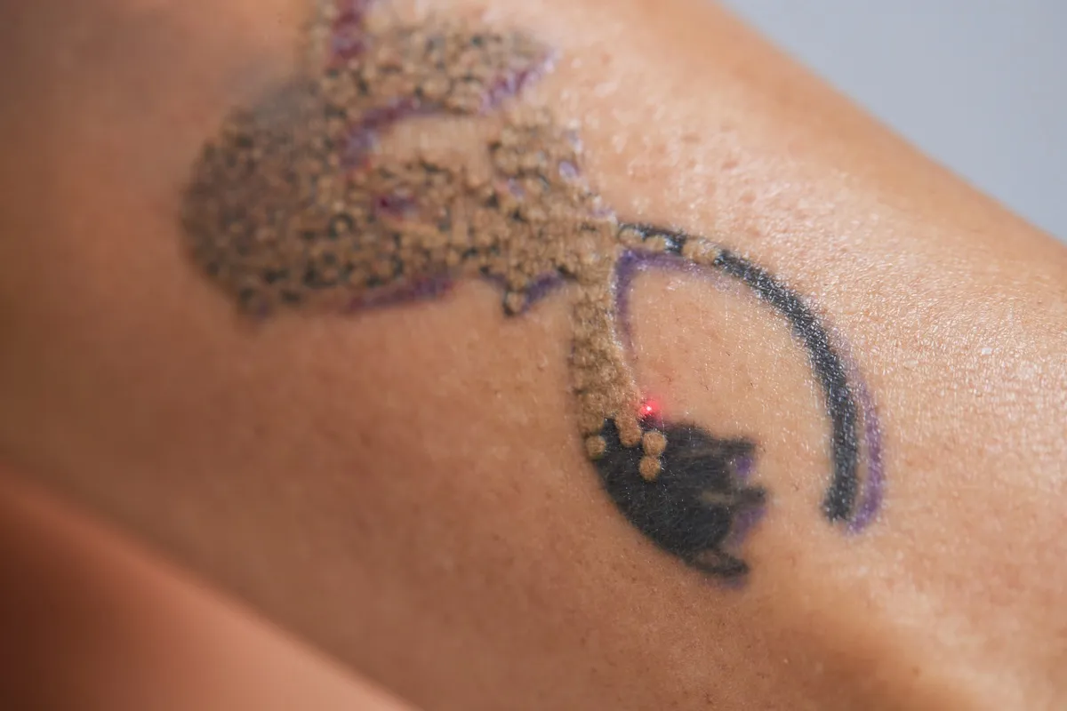 Spider vein condition on skin before treatment
