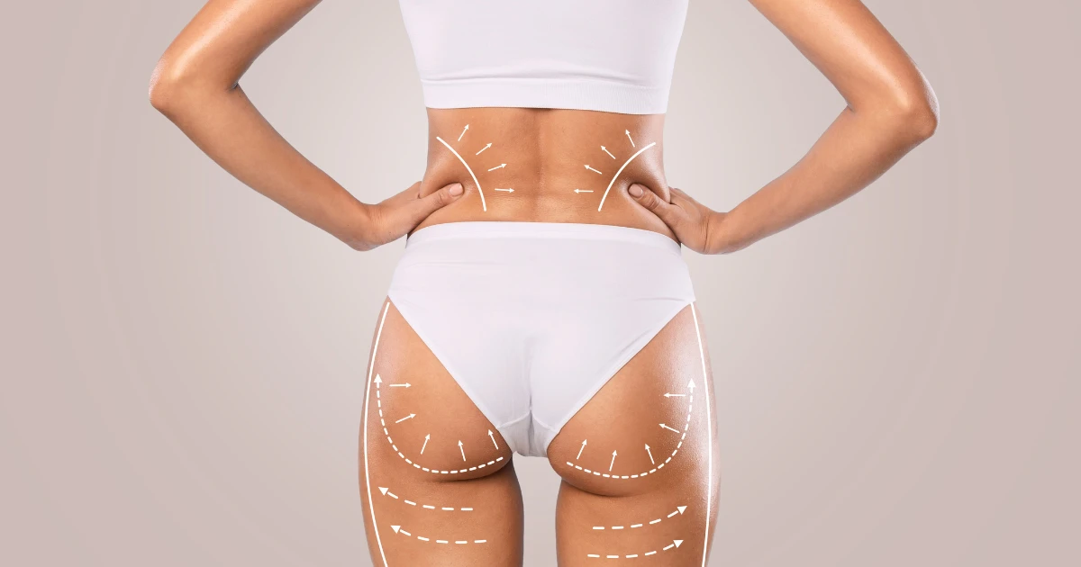 Cellulite reduction results after body contouring