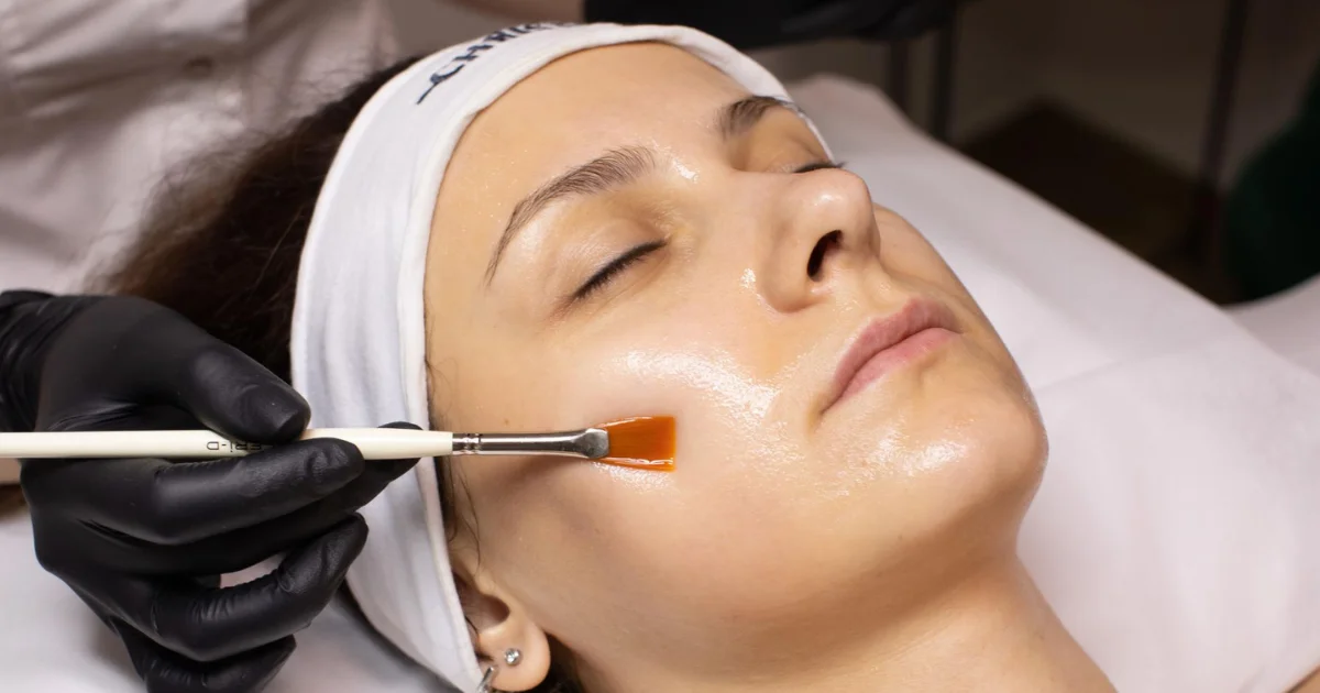 Woman receiving a professional chemical peel treatment for hyperpigmentation